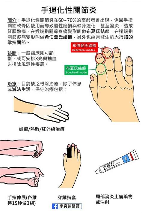 退化 性 關節 炎 手指